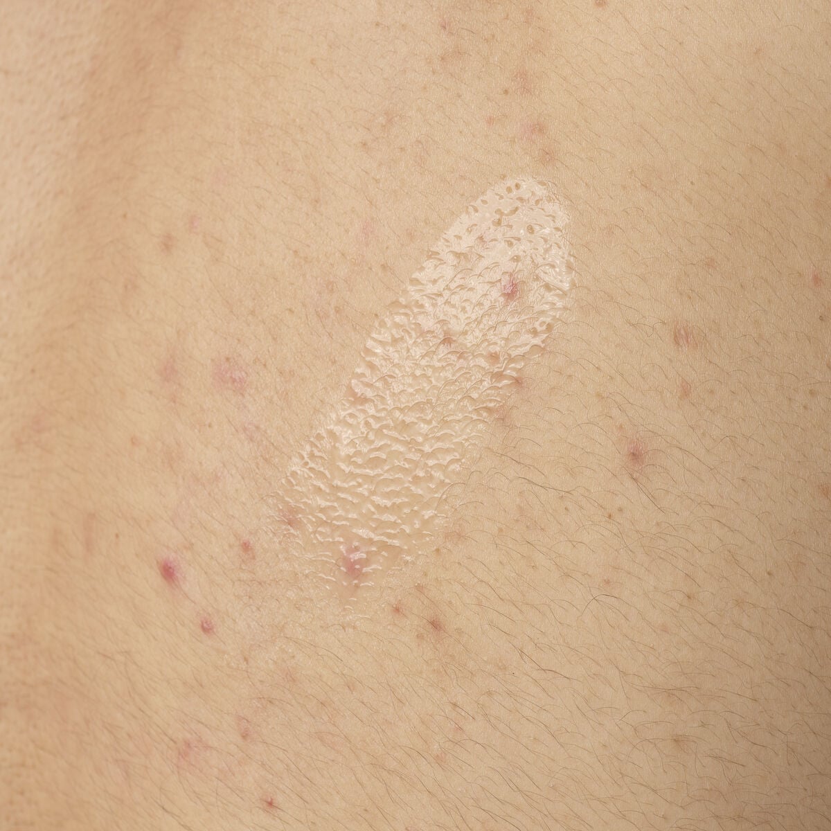 salicylic-acid-0-5-body-serum-s4 ORD-salicylic-acid-05-body-240ml-application.jpg