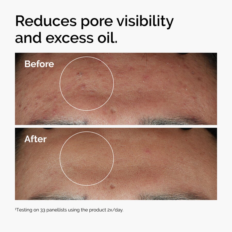 niacinamide-10-zinc-1-g4 ord-niacinamide-zinc-blemish-serum-before-after-pores.jpg