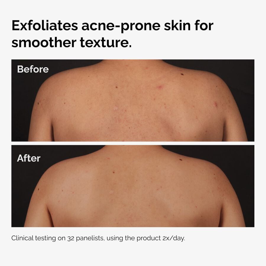 salicylic-acid-0-5-body-serum-s4 ord-salicylic-acid-body-serum-before-after-graphic-NA.jpg