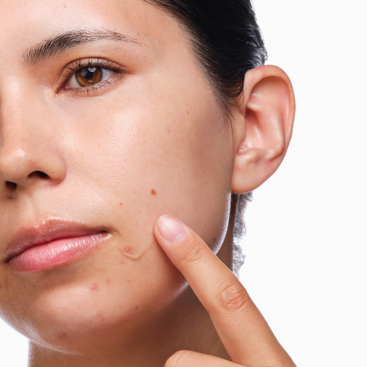 the-acne-set-u9 rdn-the-acne-set-application.png